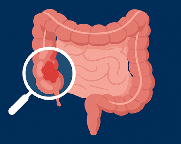 Quando procurar um coloproctologista?